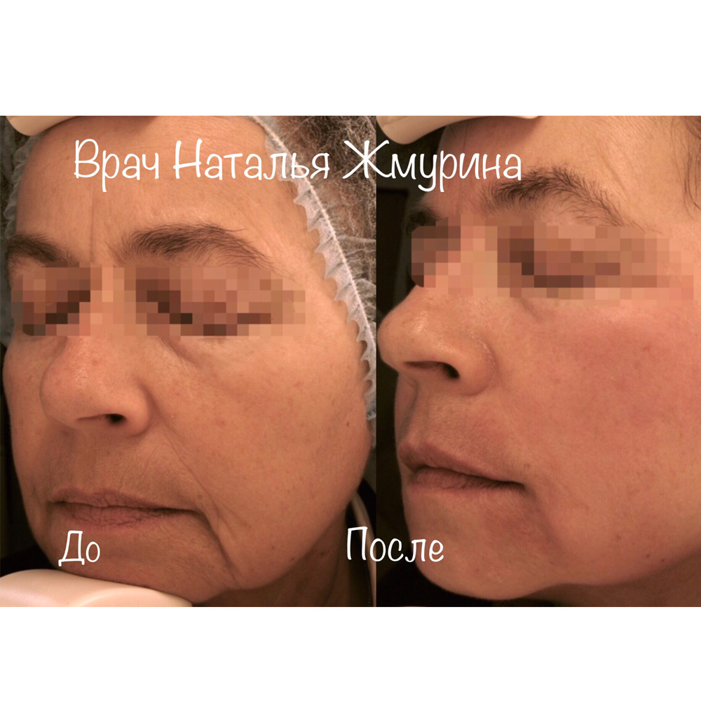 Реденсити биоревитализация. Isogei для лица до и после. Плазмолифтинг для лица при куперозе.